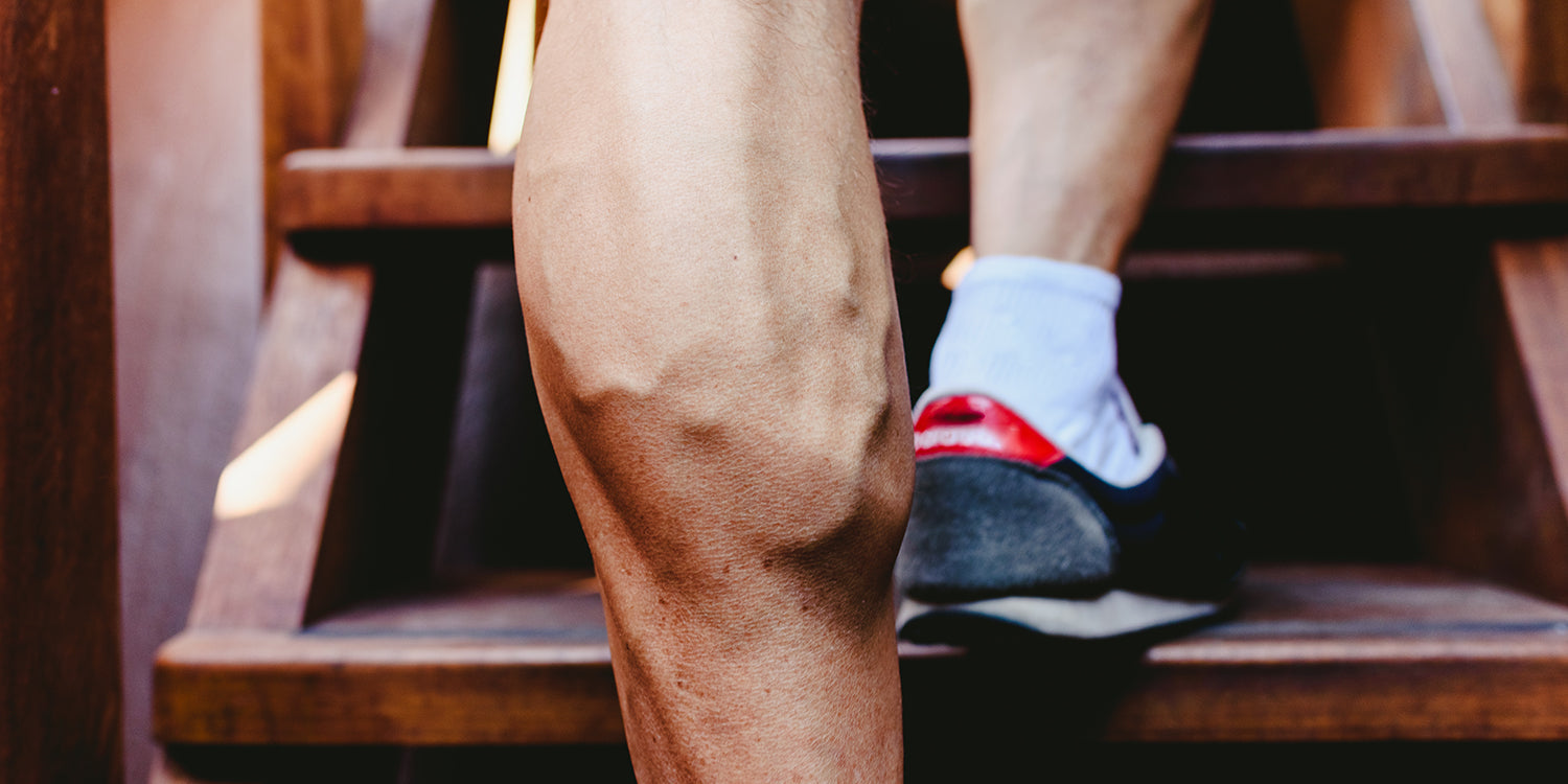 Gut sichtbare Krampfadern an den Wadenmuskeln – wie Fitness helfen oder schaden kann