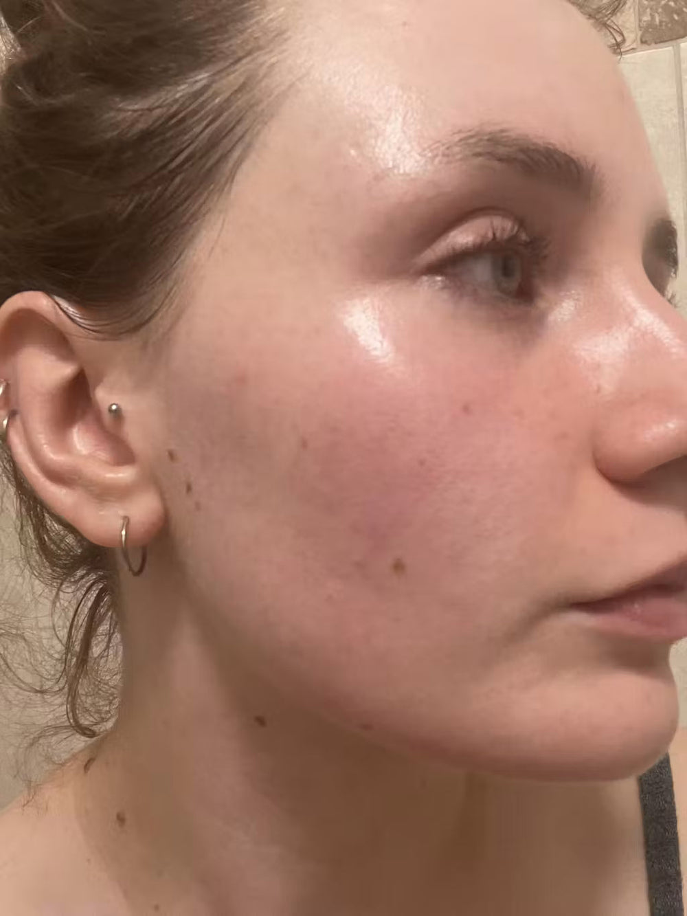 acne DE keep