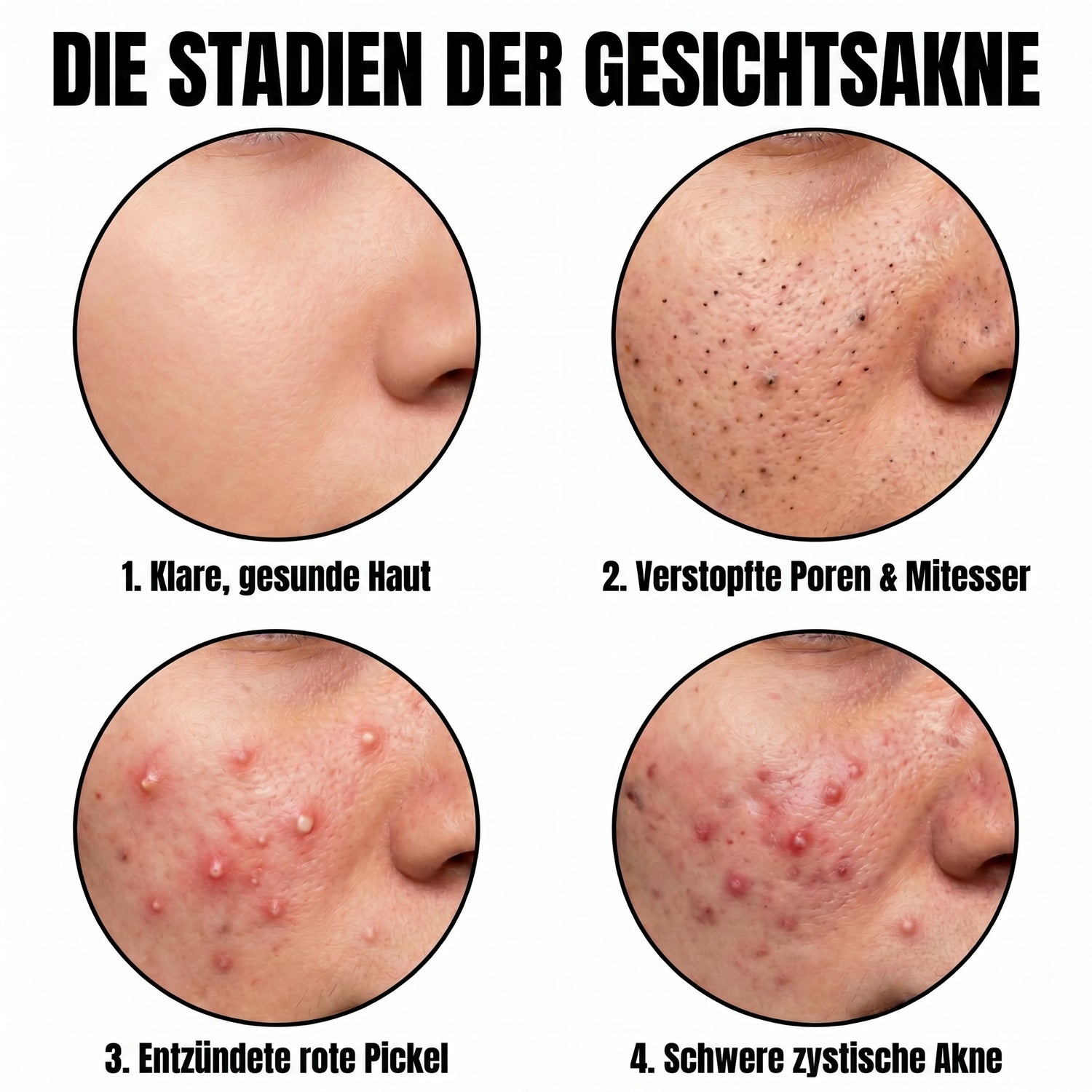 acne DE translated