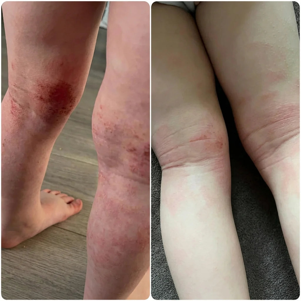 uk_eczema_child_friend.webp